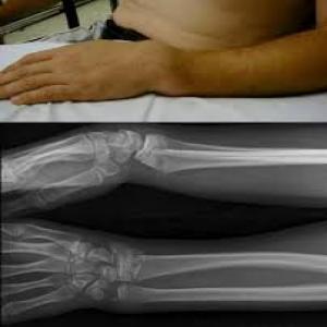 Physical therapy in colles fracture